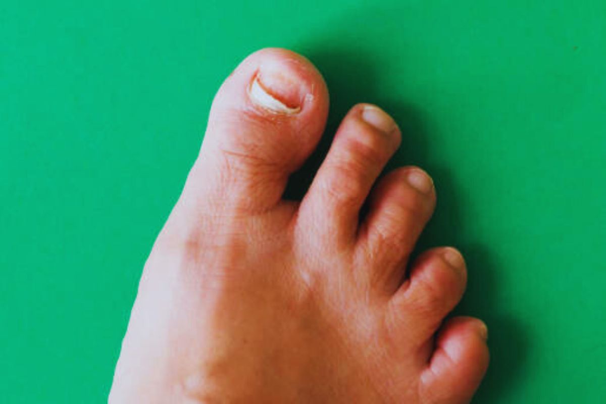 The Mystery of the Missing Nail Why Did My Toenail Fall Off Without Pain