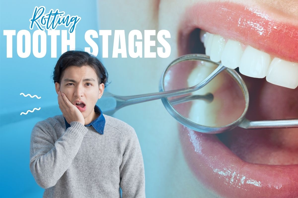 How Decay Grows Step by Step Rotting Tooth Stages